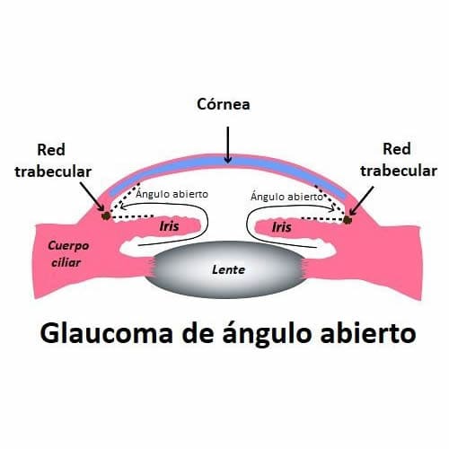 Glaucoma de Ángulo Abierto