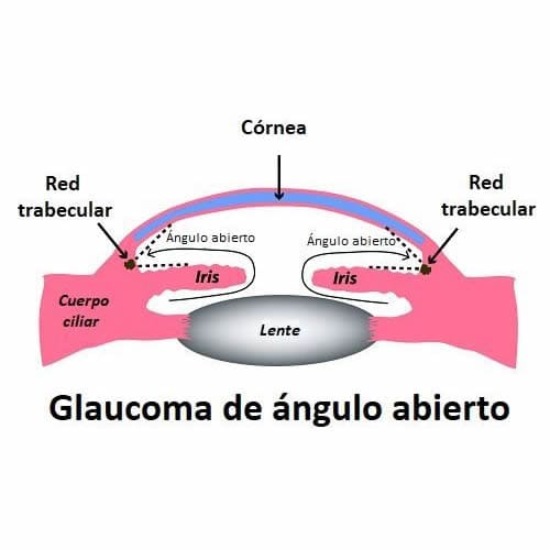 Glaucoma de Ángulo Abierto