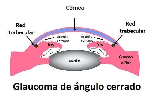 Ángulo Cerrado