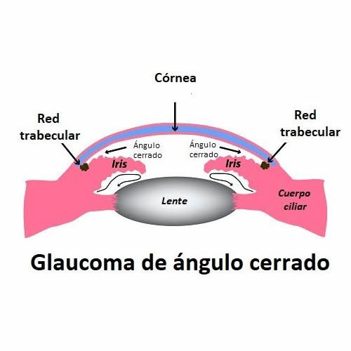 Glaucoma de Ángulo Abierto
