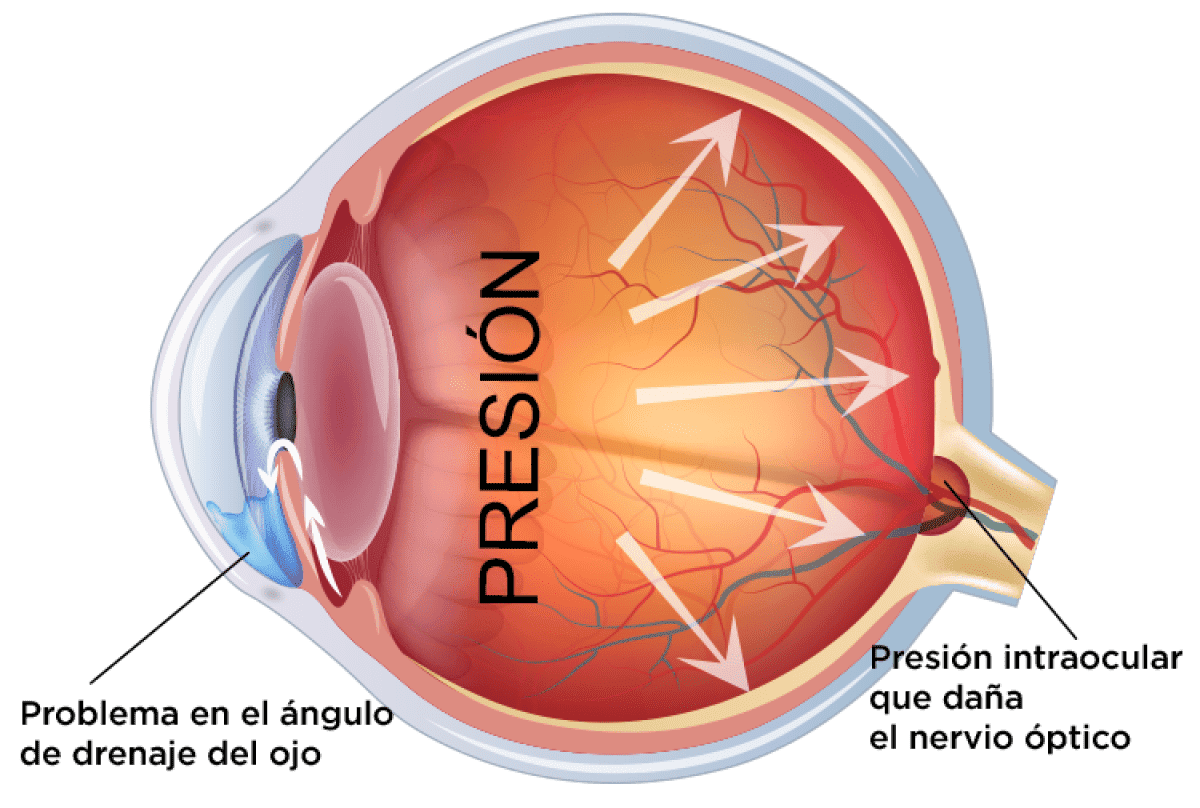 Glaucoma